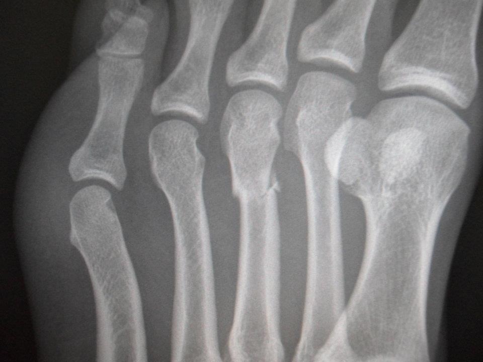 walking after 5th metatarsal fracture
